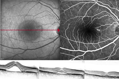 luirangiografia e oct di una retina con maculopatia.